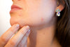 CLEAR Acne Treatment